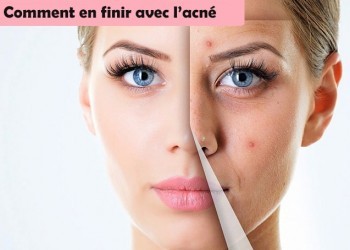 acne-stop.jpg